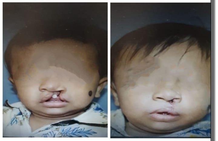 Cleft Palate Surgery